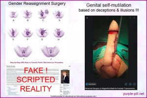 Gender Reassignment Surgery GRS